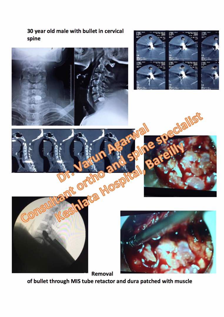Removal Of Bullet Lodged In Cervical Spine Through Minimally Invasive Tubular Retractor